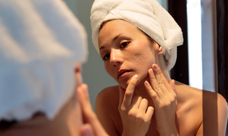 acne rimedi naturali