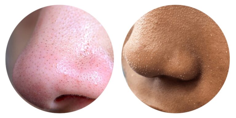 punti neri - filamenti sebacei