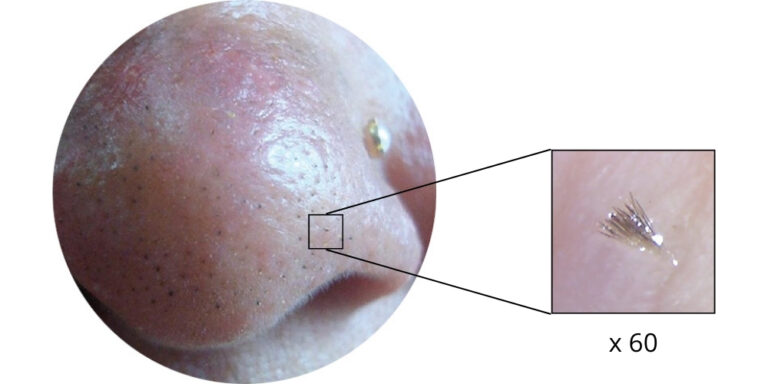 punti neri - trichostasis spinulosa