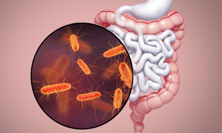 sovracrescita di metanogeni intestinali